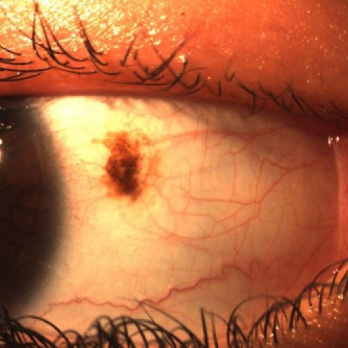 Nevus conjuntival