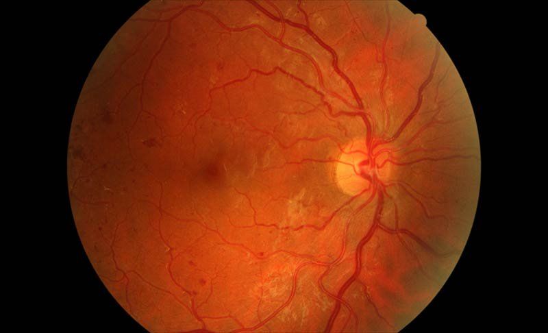 Retinopatía diabética Retinopatía diabética