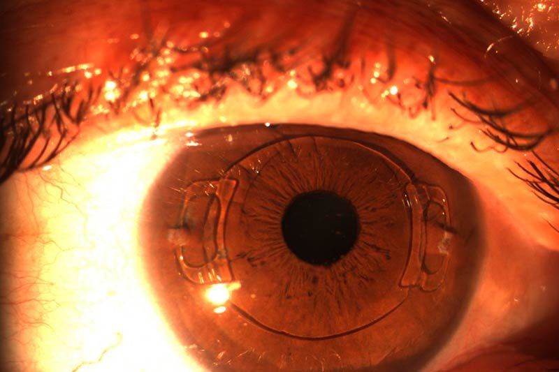 Cirugía refractiva del cristalino