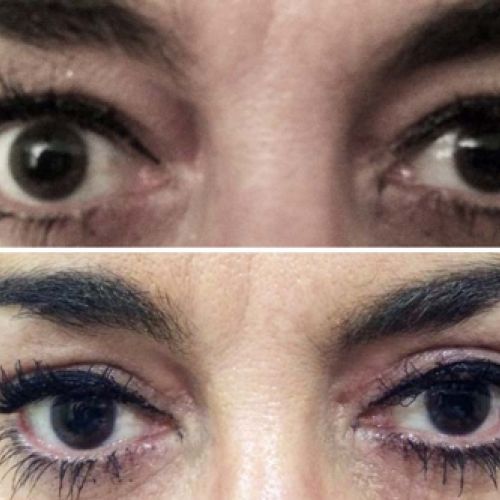 Antes y después de una intervención de blefaroplastia