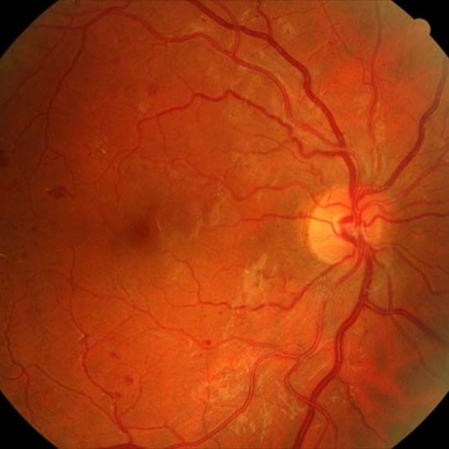 Retinopatía diabética