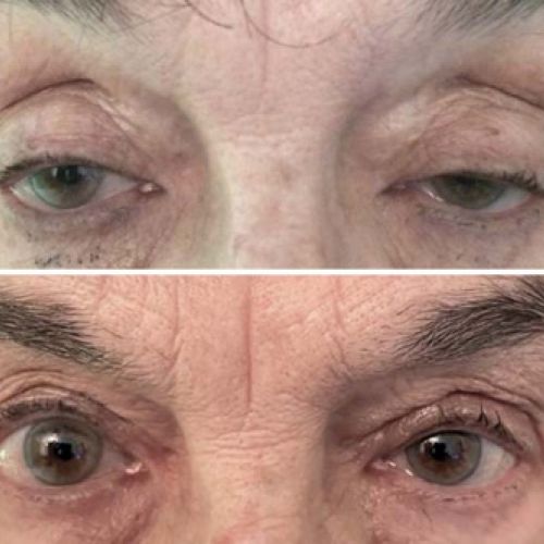 Antes y después de una intervención para corregir ptosis blefaroplastia