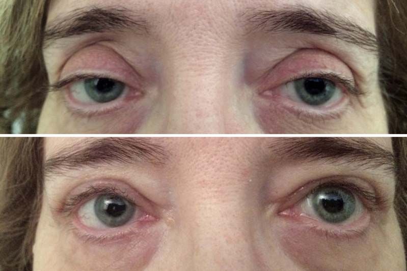 Antes y después de una intervención para corregir ptosis blefaroplastia