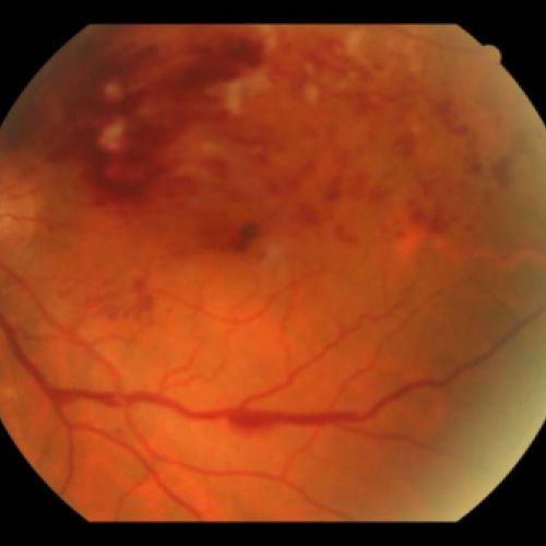 Trombosis venosa retiniana