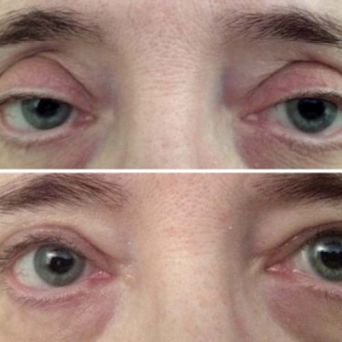 Antes y después de una intervención para corregir ptosis blefaroplastia