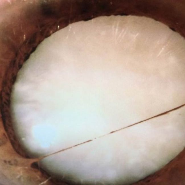 Cataratas en los ojos