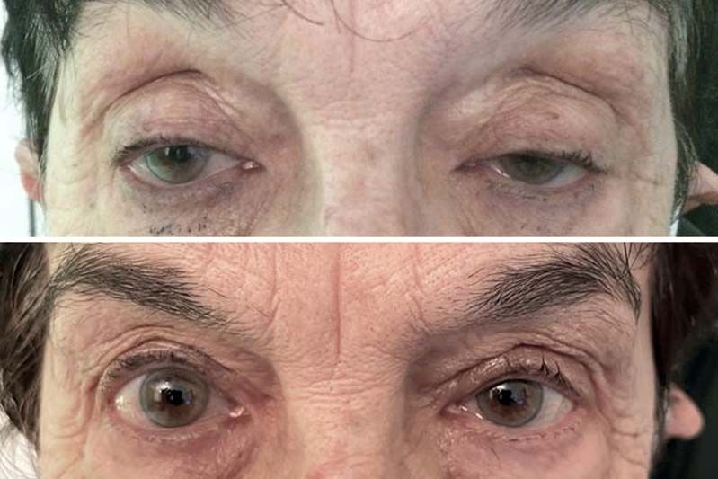 Antes y después de una intervención para corregir ptosis blefaroplastia