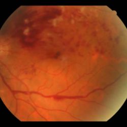 Trombosis venosa retiniana