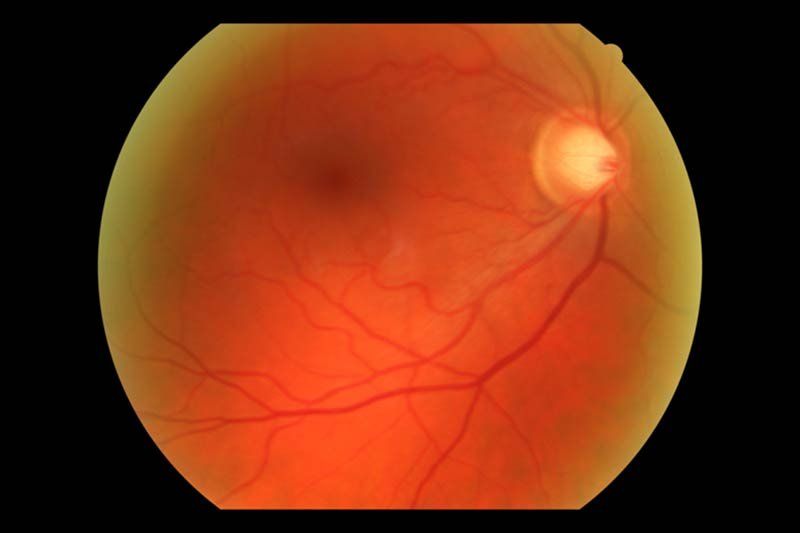 daño en nervio óptico causado por el glaucoma
