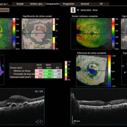 DMAE PRE Y POST TRATAMIENTO CON ANTIANGIOGENICOS