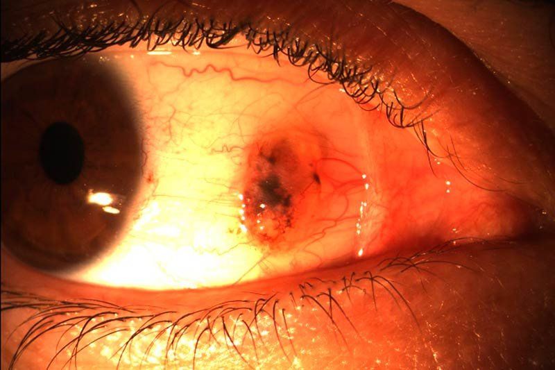 Conjuntiva Conjuntiva