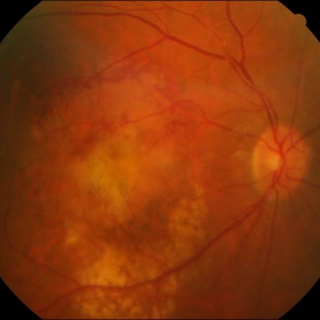 Degeneración macular