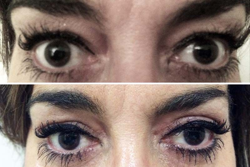 Antes y después de una intervención de blefaroplastia