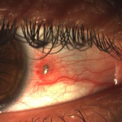 imagen de un cuerpo extraño conjuntival